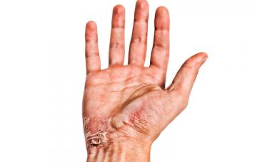 Quemaduras en la mano