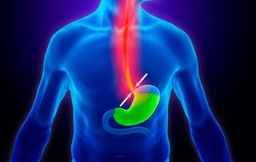 Reflujo gastroesofágico Qué es el reflujo gastroesofágico