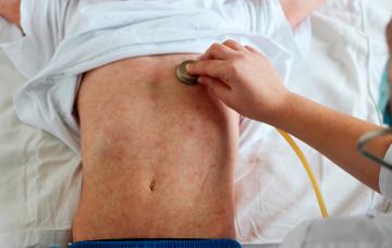 Niño con sarampión