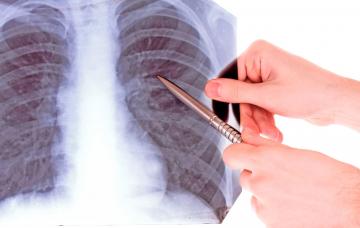 Sarcoidosis Qué es la sarcoidosis