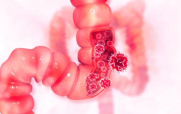 Sibo, exceso de bacterias en el intestino delgado