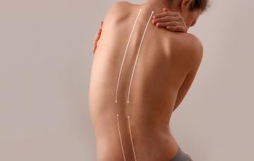 Síndrome de Marfan Qué es el síndrome de Marfan