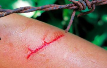 Tétanos Herida y tétanos