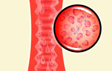 Causas de la vaginosis bacteriana