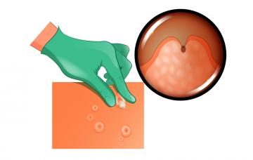 Diagnóstico del molusco contagioso