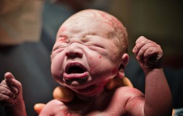 Síndrome de dificultad respiratoria neonatal Bebé con el síndrome de dificultad respiratoria neonatal