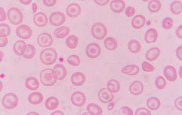 Talasemia, cómo abordar los problemas con los glóbulos rojos Talasemia