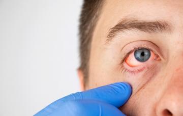 Conjuntivitis, lo mejor para aliviarla