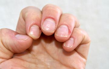 Uñas COVID tras pasar el coronavirus: qué indican Uñas COVID tras pasar el coronavirus