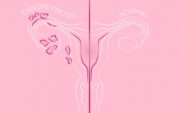 Endometriosis