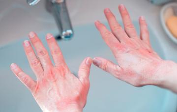 Reacciones adversas a los fármacos