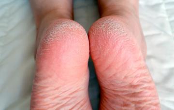 Persona con los talones agrietados y secos