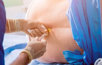 Anestesia epidural en el parto