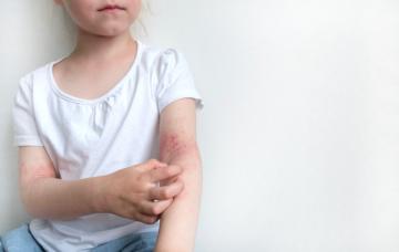 Niña se rasca las erupciones en el brazo por dermatitis atópica