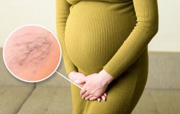 Varices vulvares durante el embarazo: cómo aliviarlas Varices vulvares