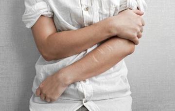 Adolescente que se ha hecho daño a sí mismo Adolescente con marcas de autolesiones en el brazo