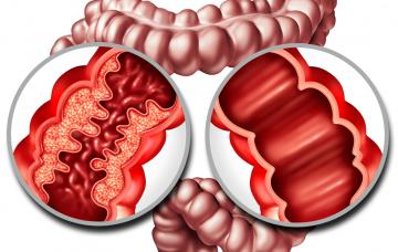 Ilustración de la enfermedad de Crohn