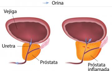 Gráfico de la hiperplasia benigna de próstata