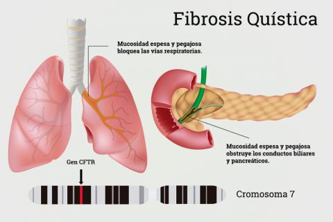 Resultado de imagen de Fibrosis quÃ­stica de pÃ¡ncreas