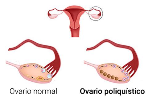 Resultado de imagen para Síndrome de Ovario Poliquístico
