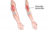 Causas de la contracción muscular en la distrofia muscular de Duchenne