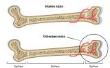 Causa de osteonecrosis