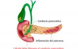Ilustración de las causas de pancreatitis