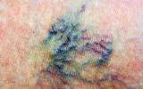 Complicaciones de varices en la piel