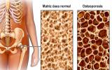 Ilustración de la densidad ósea en la osteoporosis