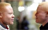 Signos y síntomas del albinismo