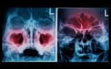 Radiografía diagnostica de la congestión nasal