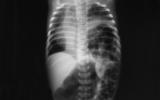 Radiografía para diagnosticar la hernia de hiato