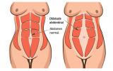 Cómo identificar si tenemos diástasis abdominal