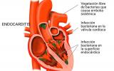Ilustración endocarditis