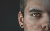 Marcas de acné y viruela en un hombre