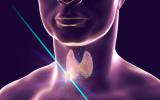 Nódulo en la tiroides