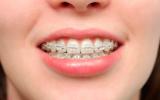 ¿Cuándo se necesita ortodoncia?