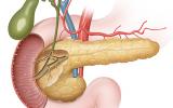 Qué son los tumores exocrinos de páncreas