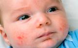 Síntomas de la alergia a las proteínas de leche de vaca en un bebé