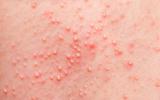 Reacción alérgica en la piel a un medicamento