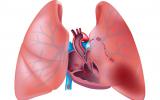 Síntomas del tromboembolismo pulmonar