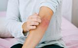 Síntomas de urticaria en el brazo