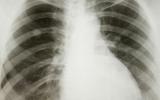 Rayos X del pulmón