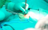 Cirugía para tratar la hernia inguinal