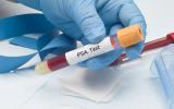 Test para detectar el cáncer de próstata