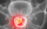 La terapia hormonal podría frenar la metástasis por cáncer de próstata
