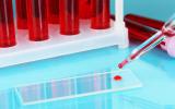Test de sangre, hasta 10 veces más sensible para detectar cáncer