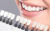 Blanqueamiento dental: técnicas para hacer lucir tu sonrisa