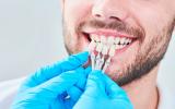 Carillas dentales, cuándo usarlas, colocación y cuidados
