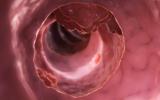 Biomarcadores para diagnosticar el cáncer de colon 